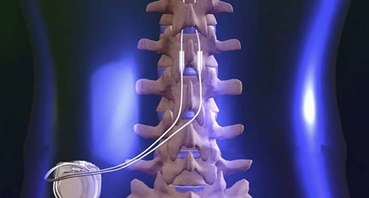 Spinal Cord Stimulator Implant Placement