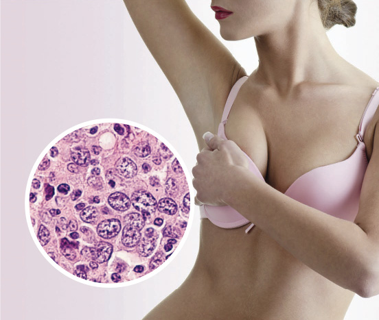 BIA-ALCL Symptoms BIA-ALCL