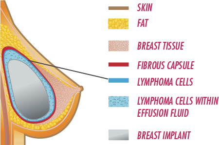 Textured Implant Layers BIA-ALCL