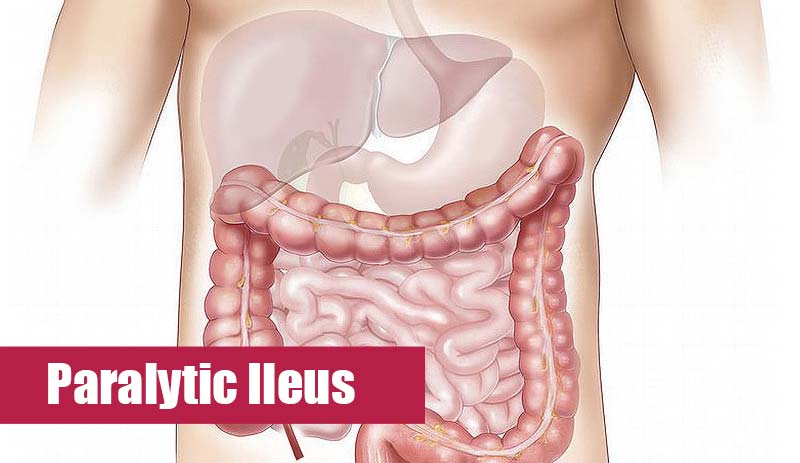 Paralytic Ileus