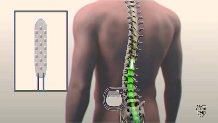 Spinal Cord Stimulator Placement