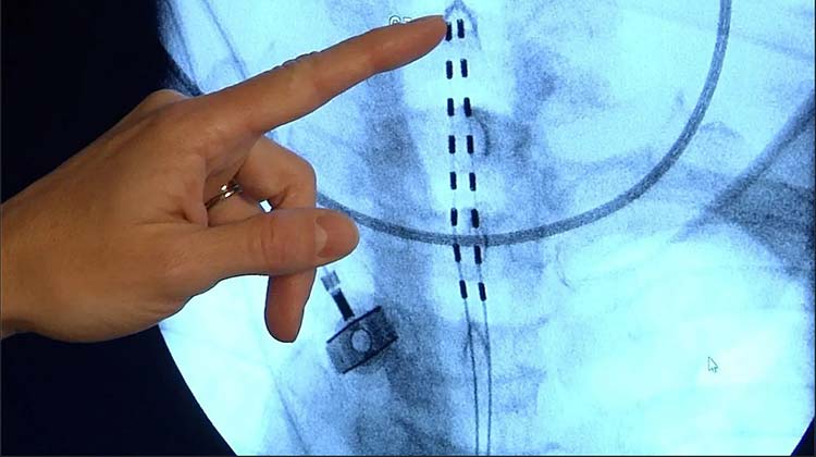 Spinal Cord Stimulator Implant