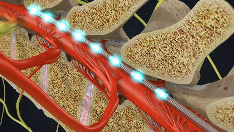 spinal stimulator electrode