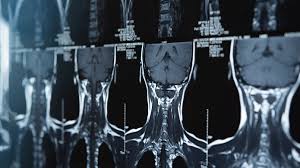 spinal cord injury