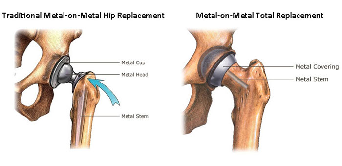 Knee Replacment